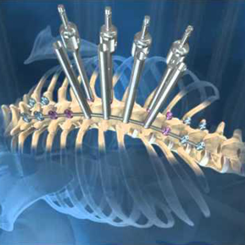 medtronic-mast - HCM Ortho Others Spinal Implants