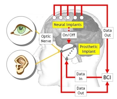 160.implants - HCM Ortho Neuro Implant