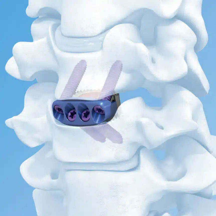 cervial-cage - HCM Ortho Cervical Cages manufacturer