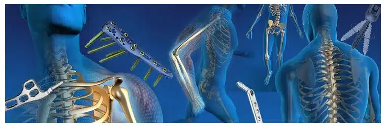 trauma-implants - HCM Ortho trauma-implants